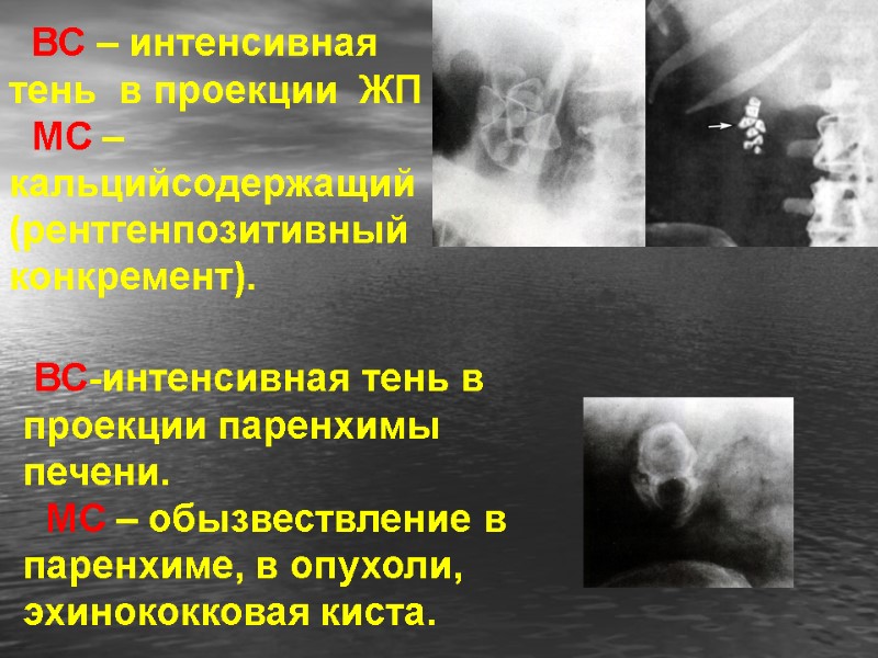 ВС – интенсивная  тень  в проекции  ЖП   МС –